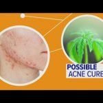 Can CBD oil really help with acne?