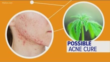 Can CBD oil really help with acne?
